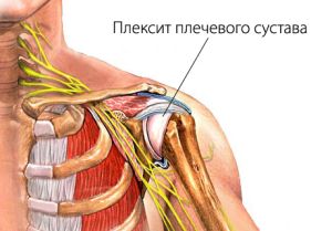Лечение плексита плечевого сустава отзывы