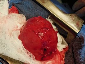 Операции на кисту поджелудочной железы отзывы thumbnail